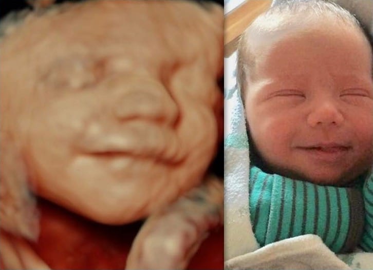 A 4D Ultrasound compared to the birth photo.